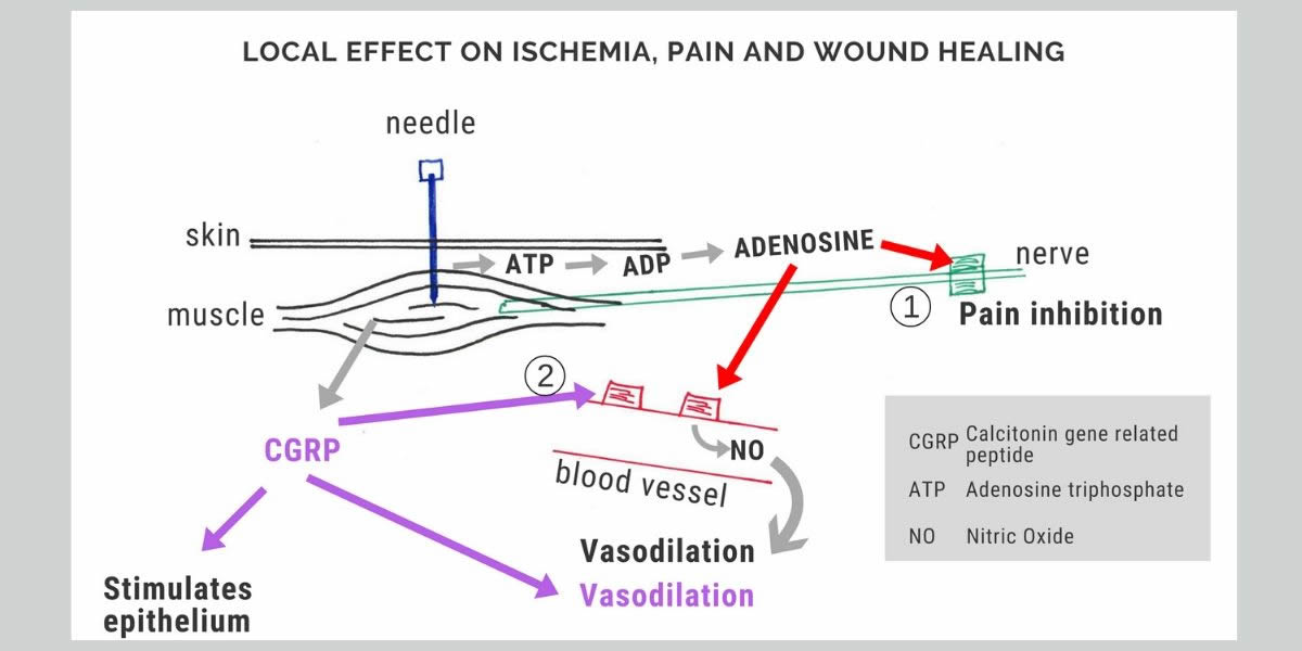 Acupuncture Explained - Tell me more - Local effect