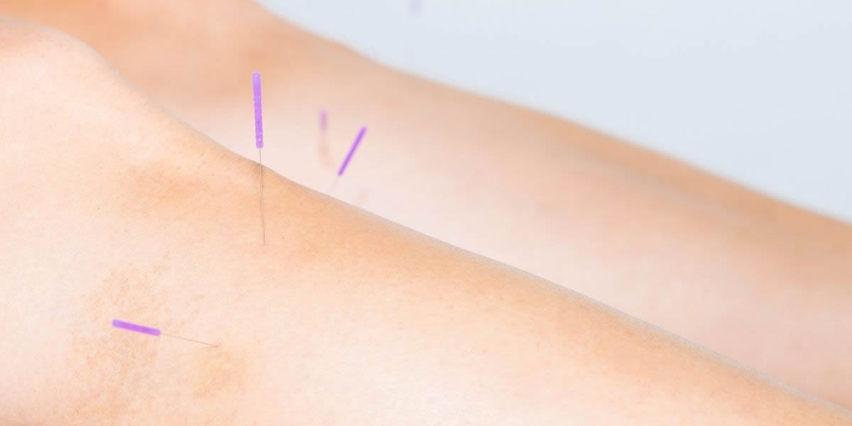 Acupuncture Explained